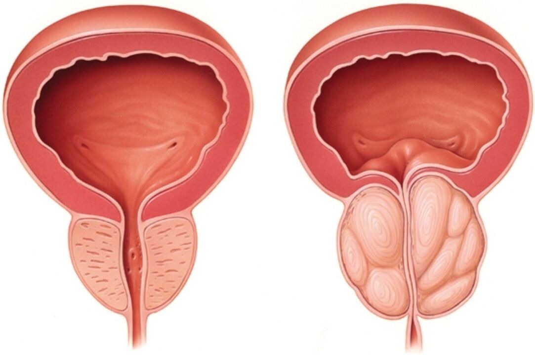 Prostată normală (stânga) și cu semne de inflamație în prostatita (dreapta)