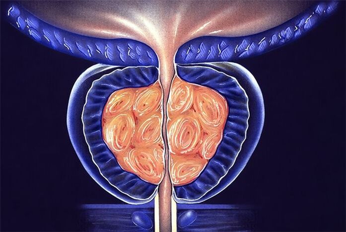 inflamația prostatei la bărbați