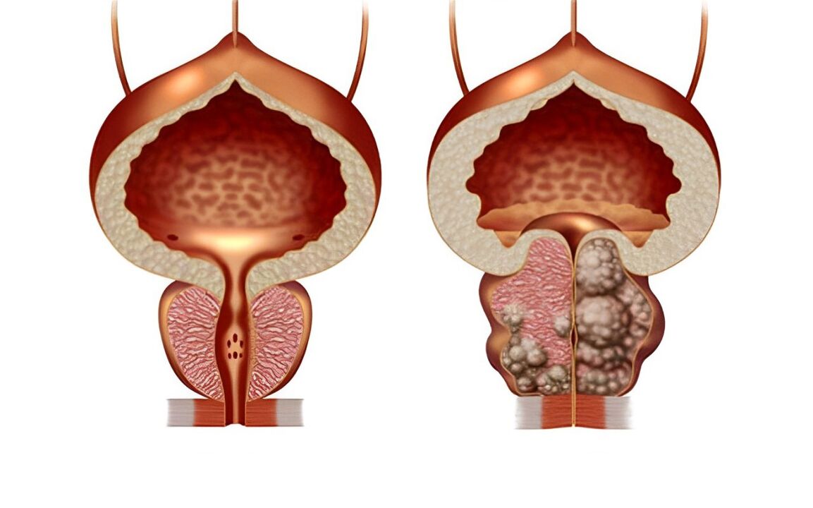 cum arată adenomul de prostată 