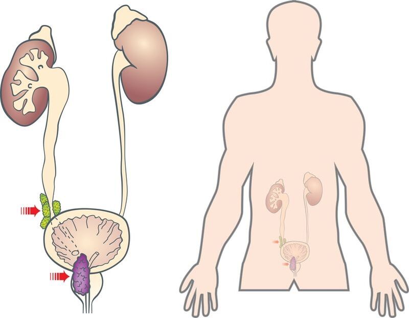 simptome și cauze ale adenomului de prostată