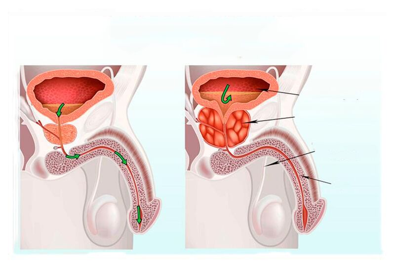 norma și inflamația glandei prostatei