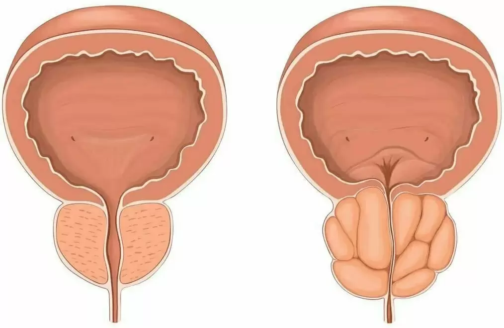 Prostată normală și prostată dureroasă
