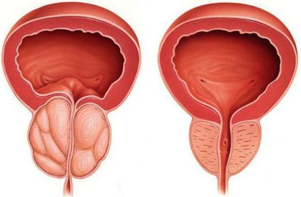 prostată sănătoasă și inflamată cu prostatită